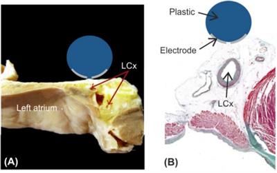 Epicardial pulsed-field ablation-impact of electric field and heat distribution induced by coronary metallic stents